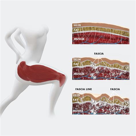 fascia blasting results|FasciaBlaster: What It Is & How It Works .